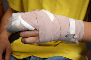 Person with cast after burn injury